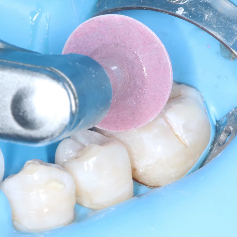 40 Stuks Tandheelkundige Polij - Teeth Whitening Express recensie en prijs