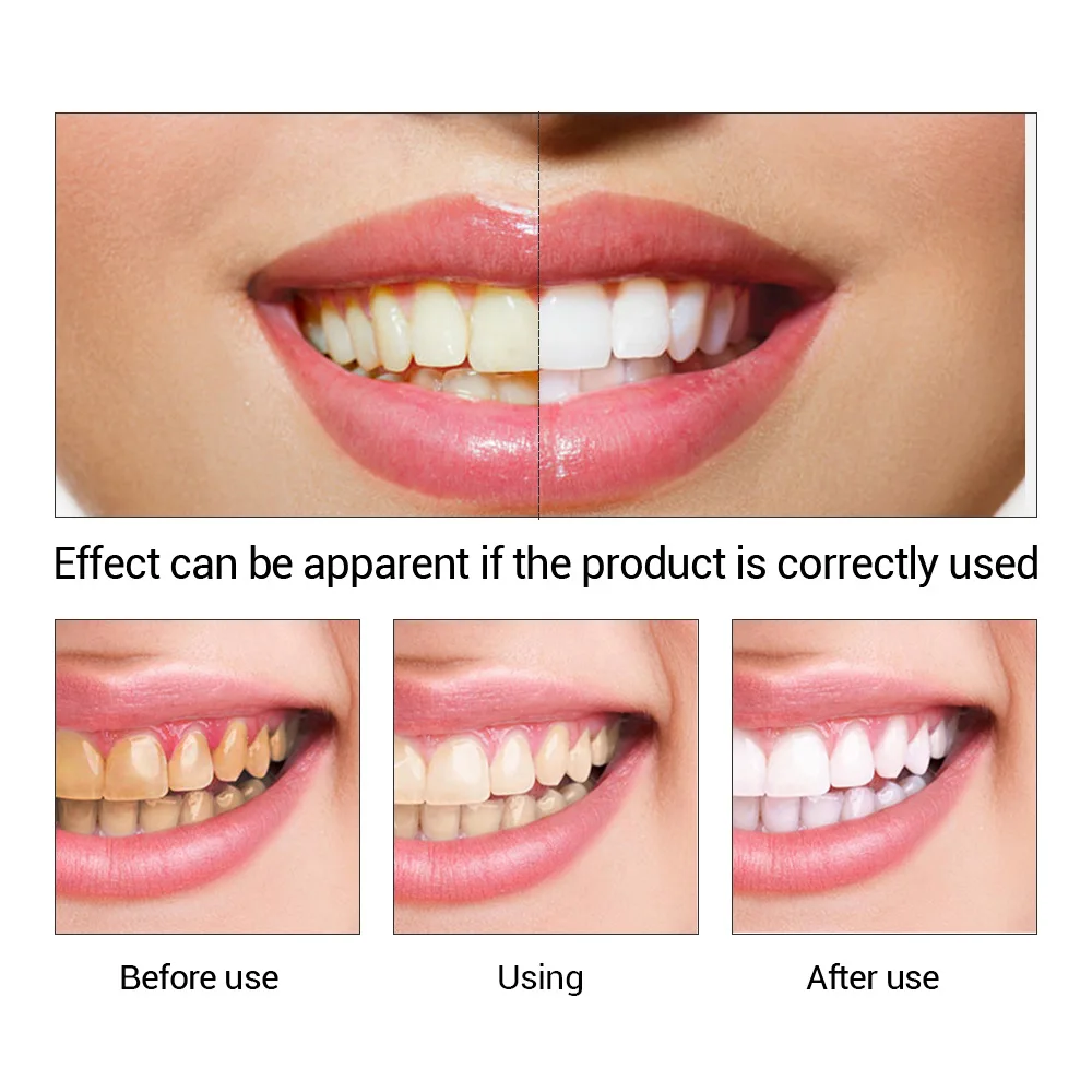 Fteenply Tanden Whitening Esse - Teeth Whitening Clinic recensie en prijs