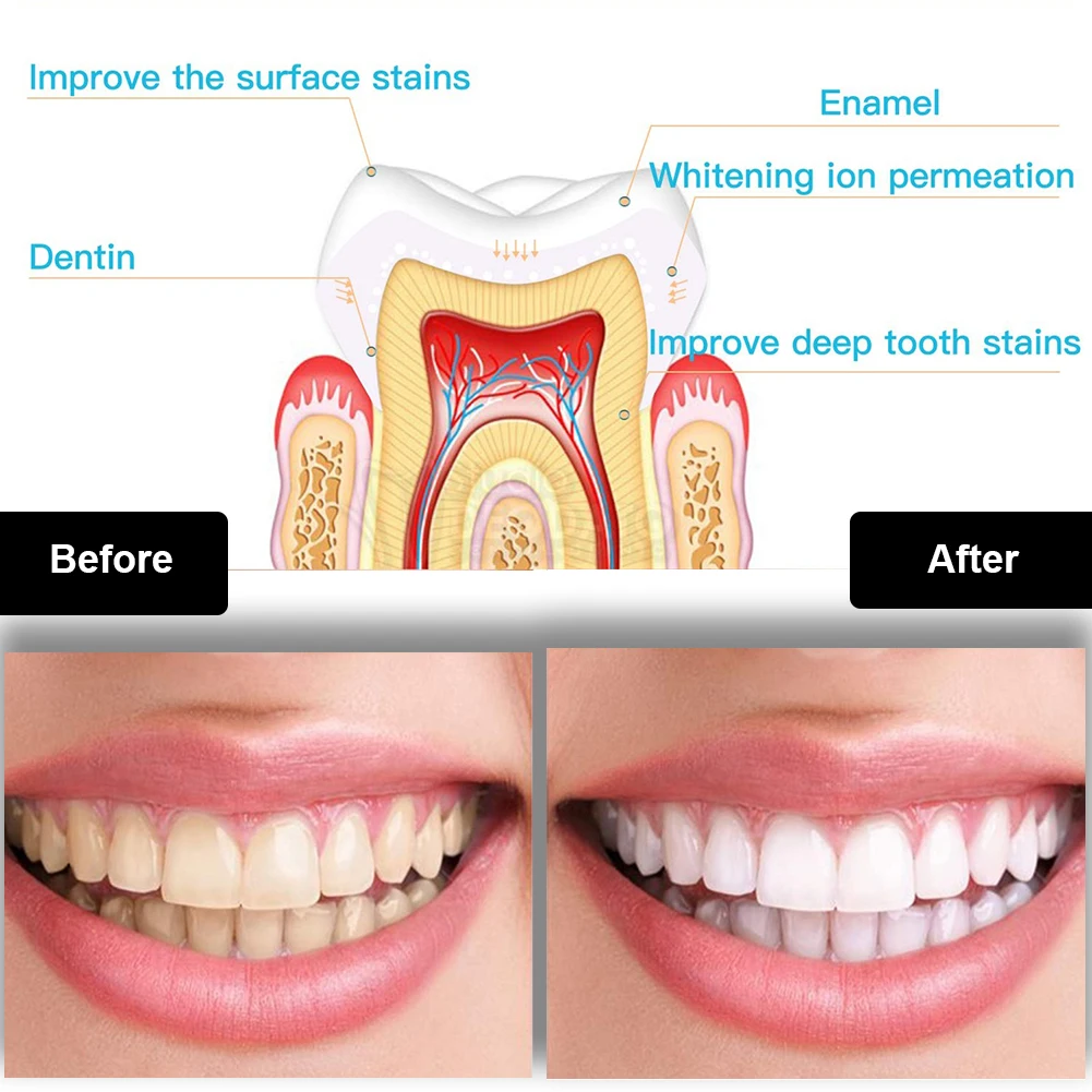 Tandheelkundige Tanden Whiteni - Teeth Whitening For Trays recensie en prijs